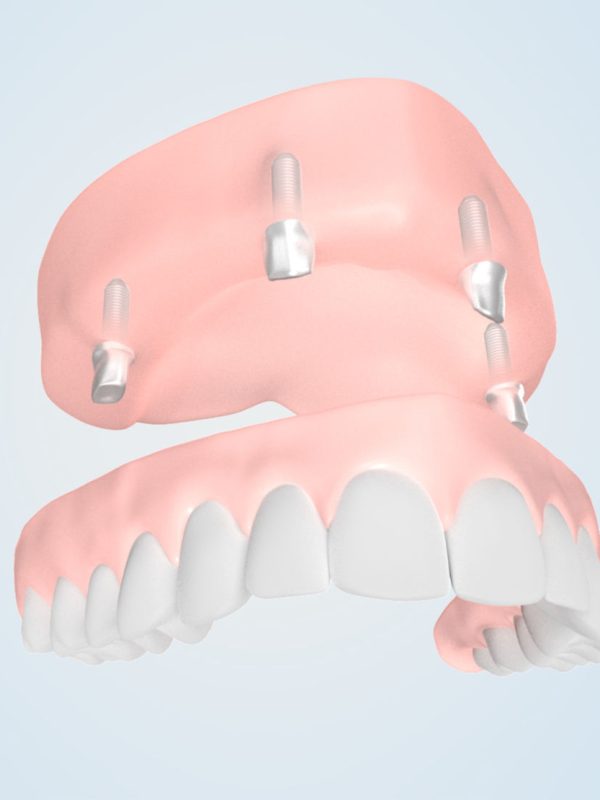 Teleskopkronen-auf-4-Implantaten-im-Oberkiefer_2